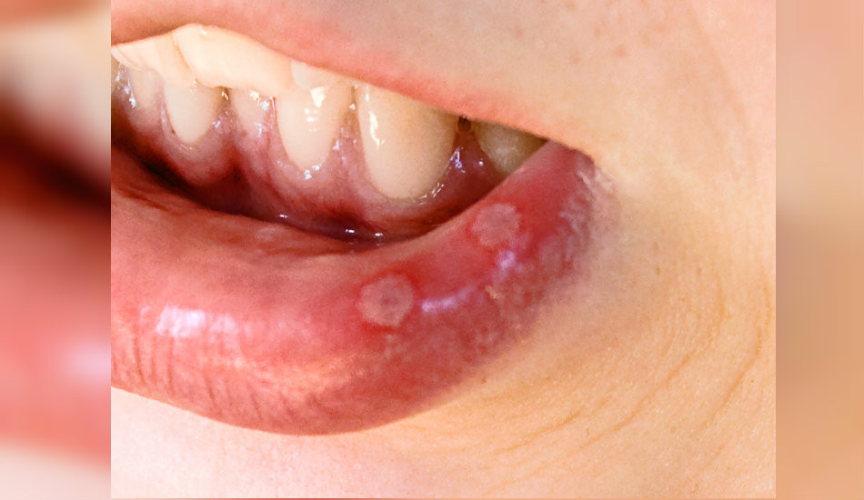 Canker Sores On Your Lips